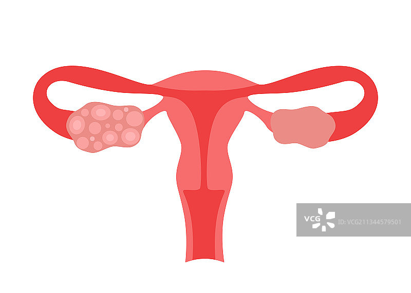 多囊卵巢综合征（PCOS）女性图片素材