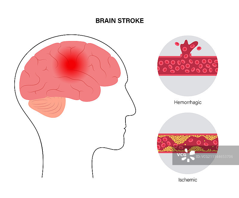 缺血性和出血性脑卒中图片素材
