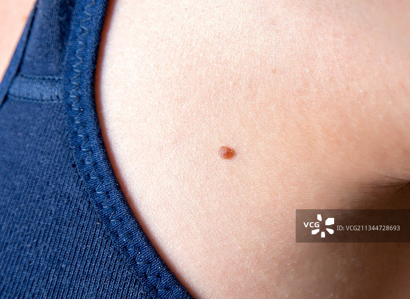 女性身体上的痣特写图片素材