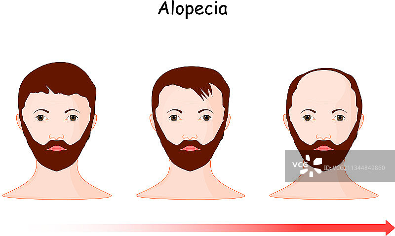 脱发秃顶图片素材