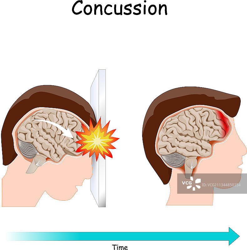 头部外伤后的脑震荡图片素材