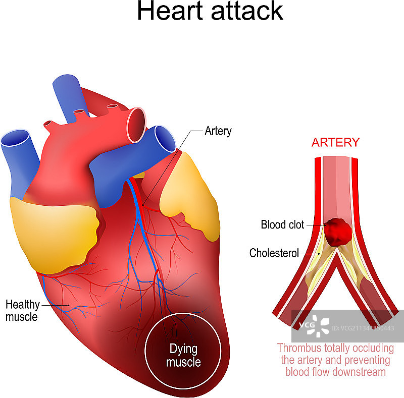 心肌梗死图片素材