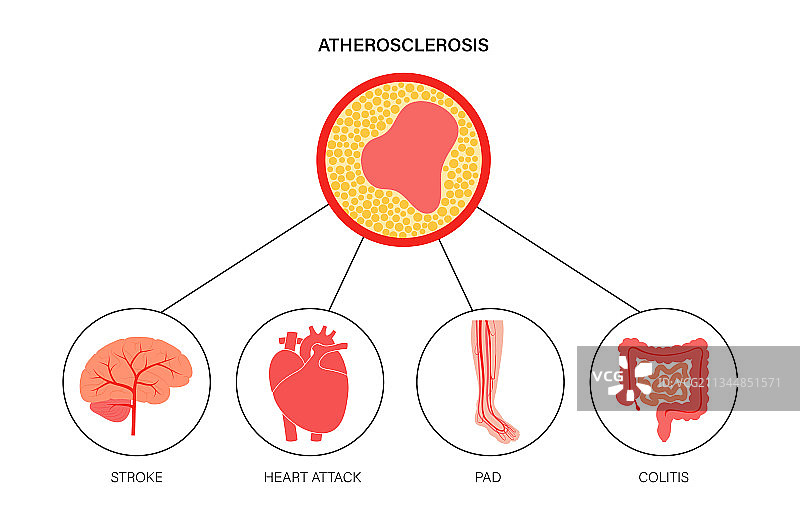 缺血类型图片素材