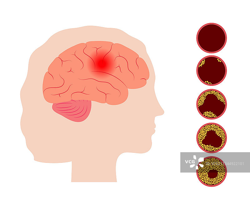 脑卒中缺血图片素材