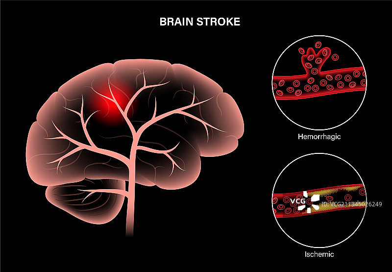 缺血性和出血性脑卒中图片素材