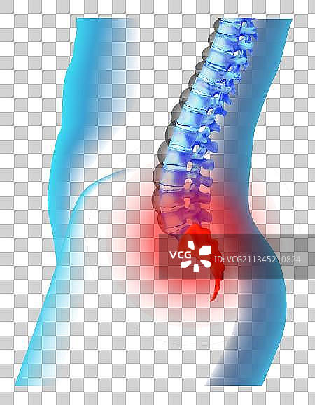 腰间盘突出示意图图片素材