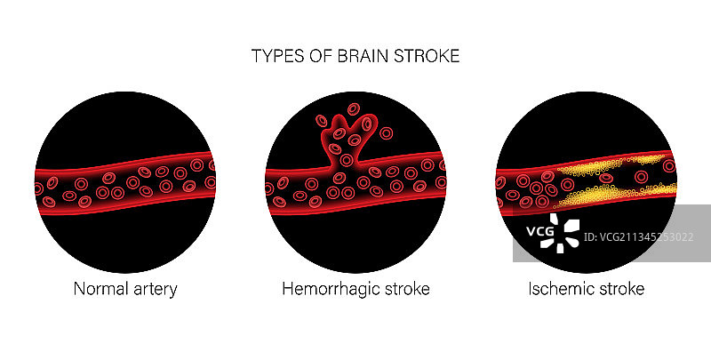 缺血性和出血性脑卒中图片素材