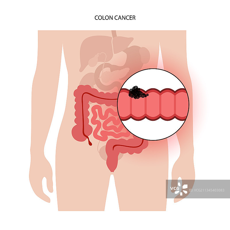 结肠癌分期图片素材