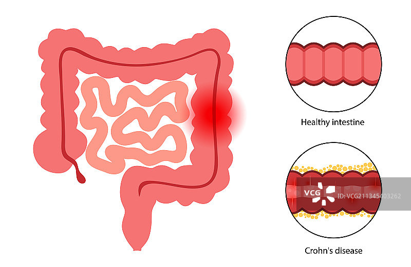 克罗恩病概念图片素材