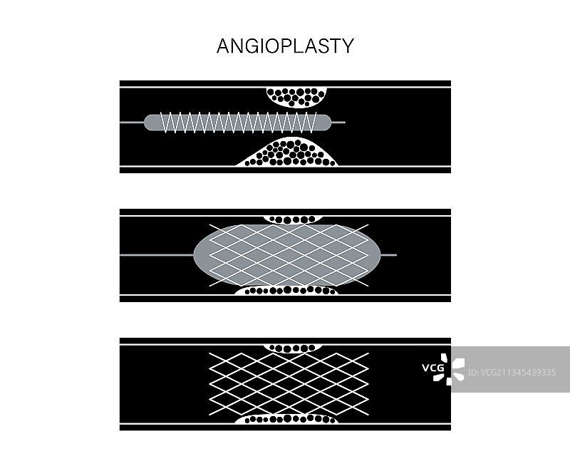 血管成形术心脏支架图片素材