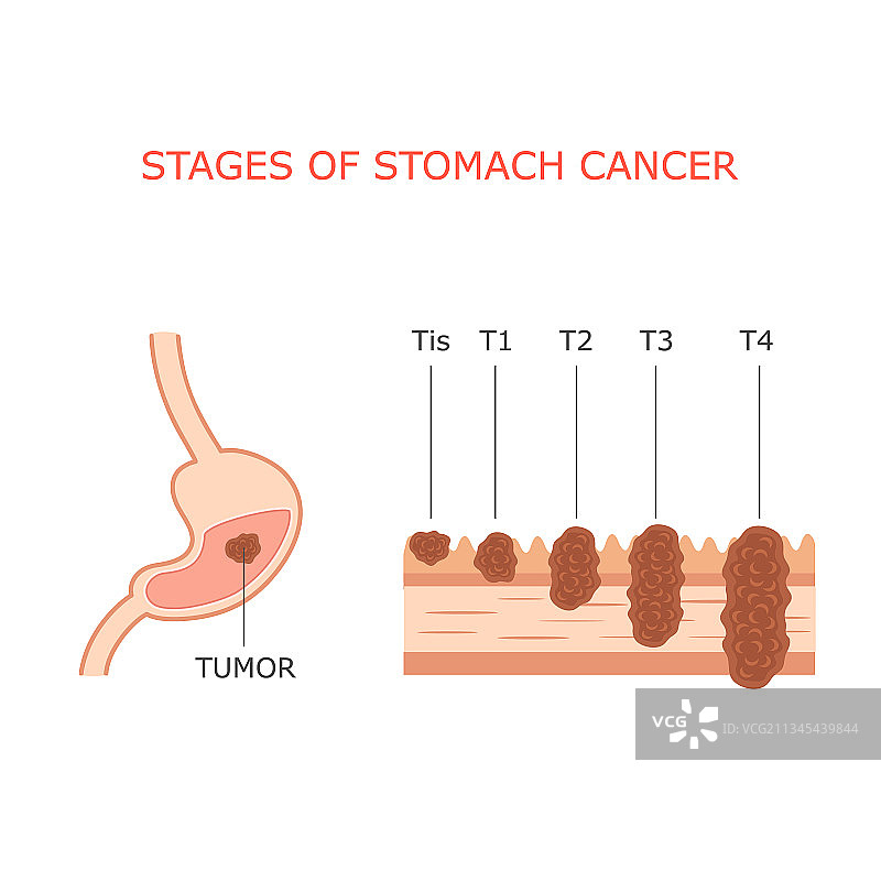 胃癌分期图片素材