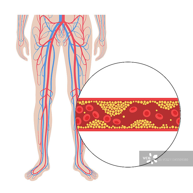 外周动脉疾病图片素材