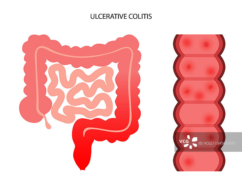 溃疡性结肠炎图片素材