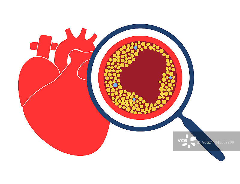 胆固醇与心脏疾病图片素材