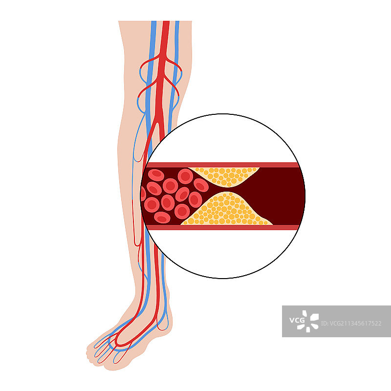 外周动脉疾病图片素材