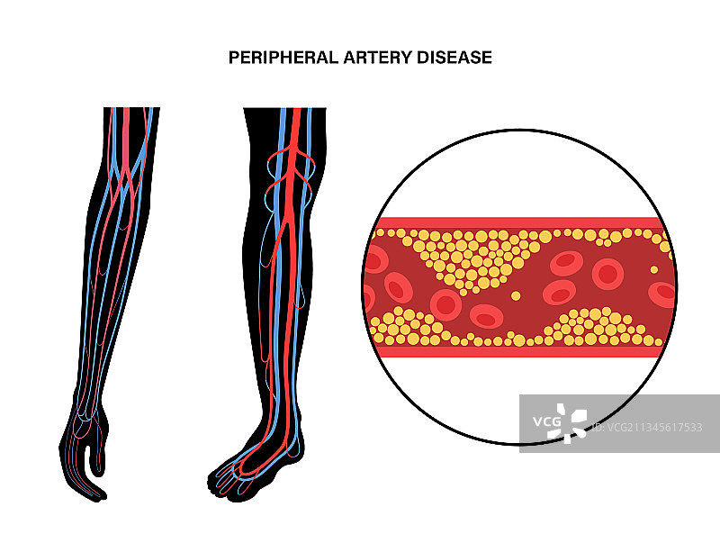 外周动脉疾病图片素材