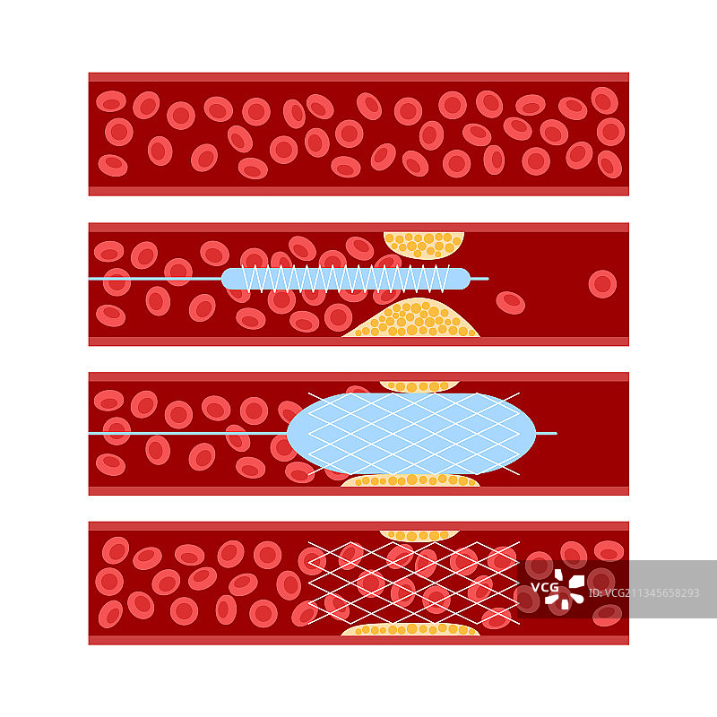 血管成形术心脏支架图片素材