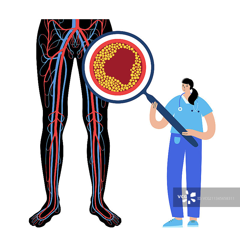 外周动脉疾病图片素材