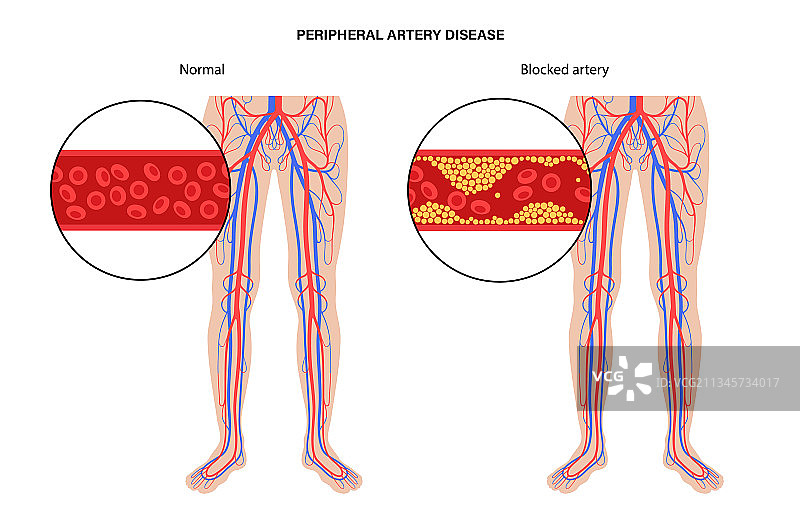 外周动脉疾病图片素材