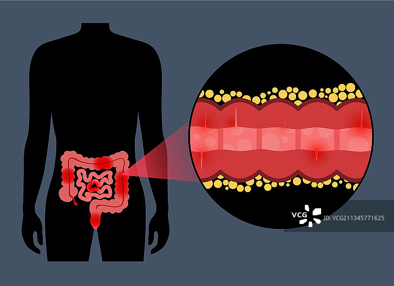 克罗恩病概念图片素材