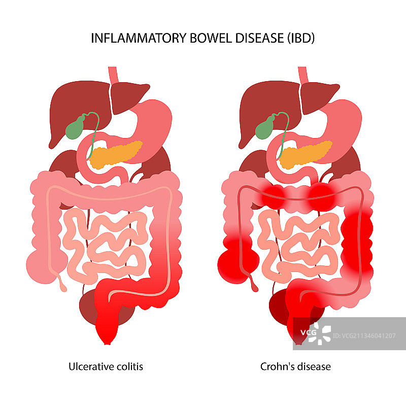炎症性肠病图片素材