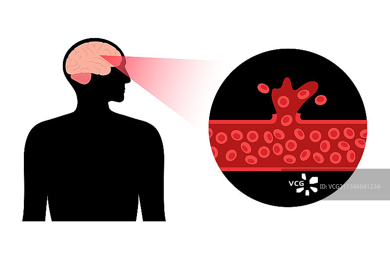 出血性脑卒中图片素材