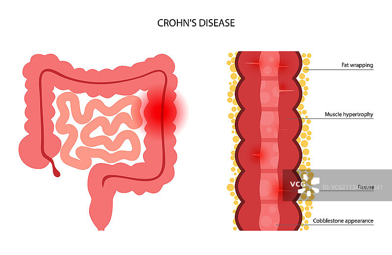 克罗恩病概念图片素材