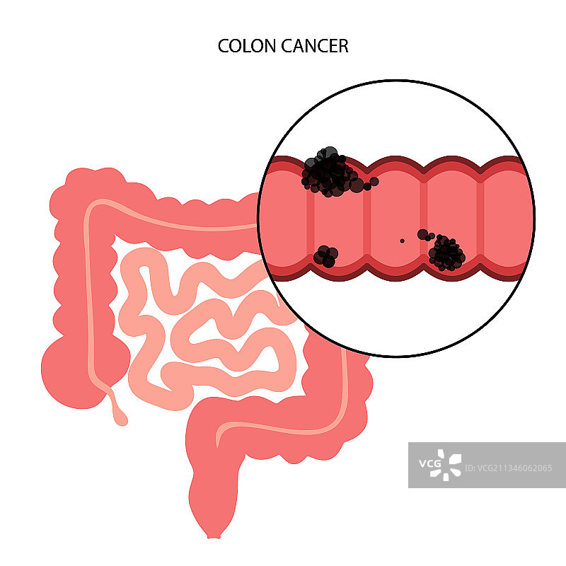 结肠癌分期图片素材