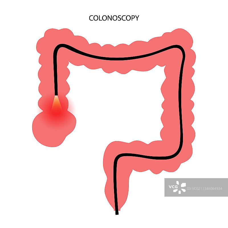 结肠镜检查概念图片素材