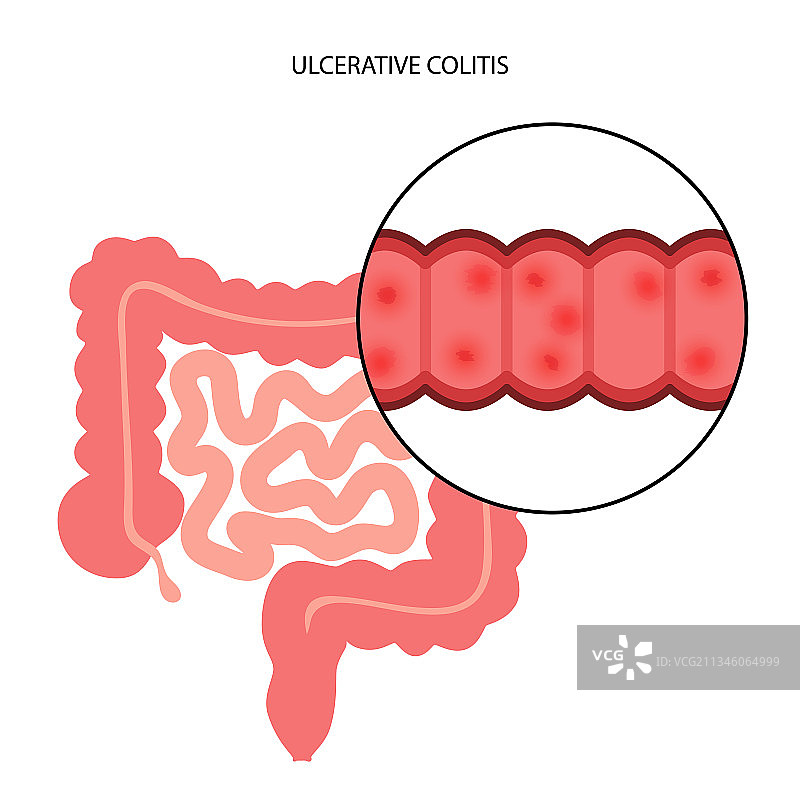 溃疡性结肠炎图片素材