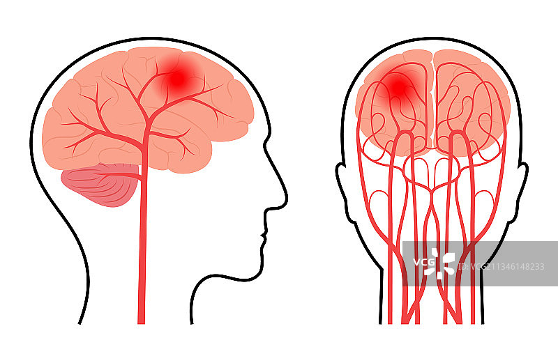 脑部疼痛疾病图片素材