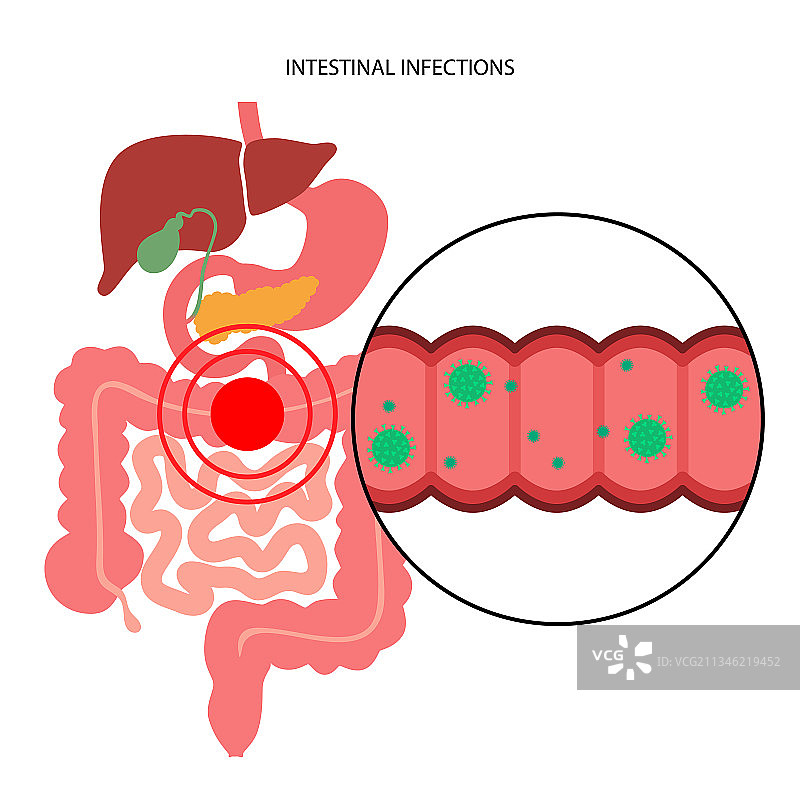 肠道感染疾病图片素材