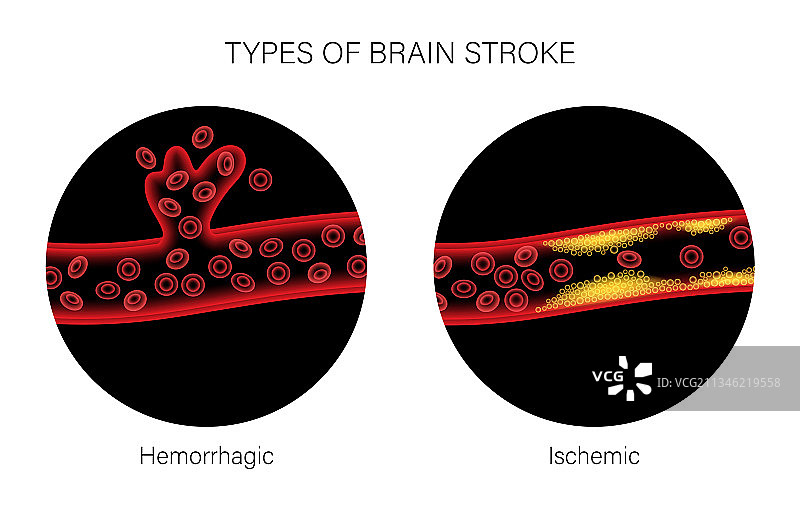 缺血性和出血性脑卒中图片素材