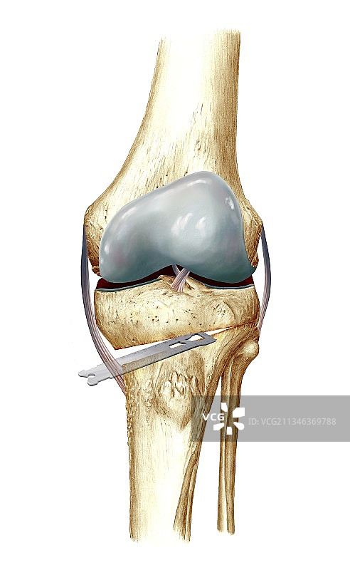 膝关节截骨术医学插画图片素材