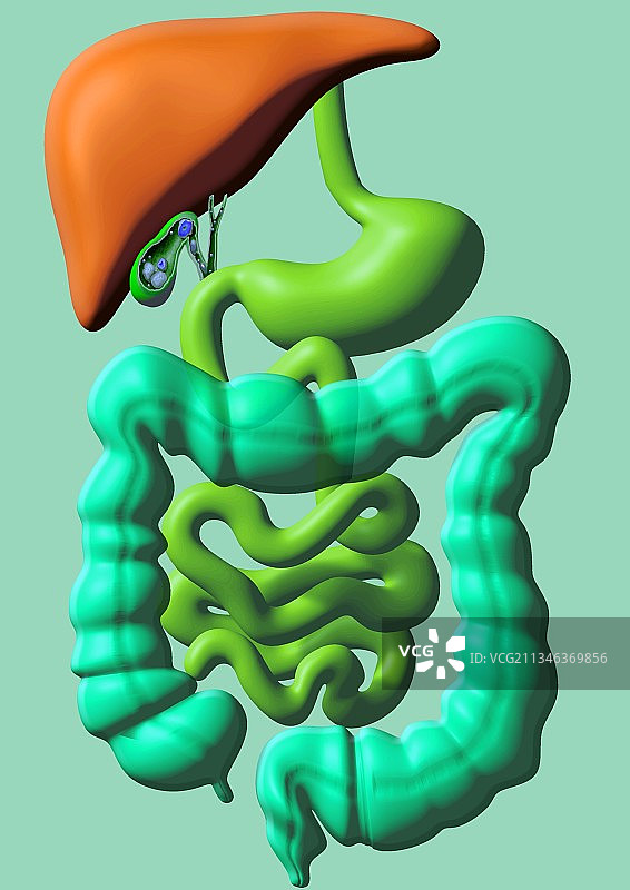 胆结石艺术作品图片素材