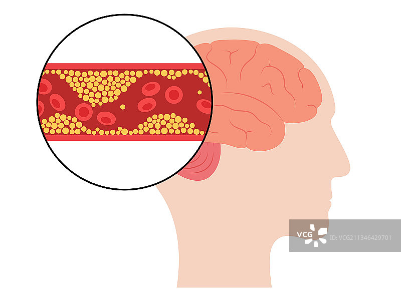 脑卒中缺血图片素材