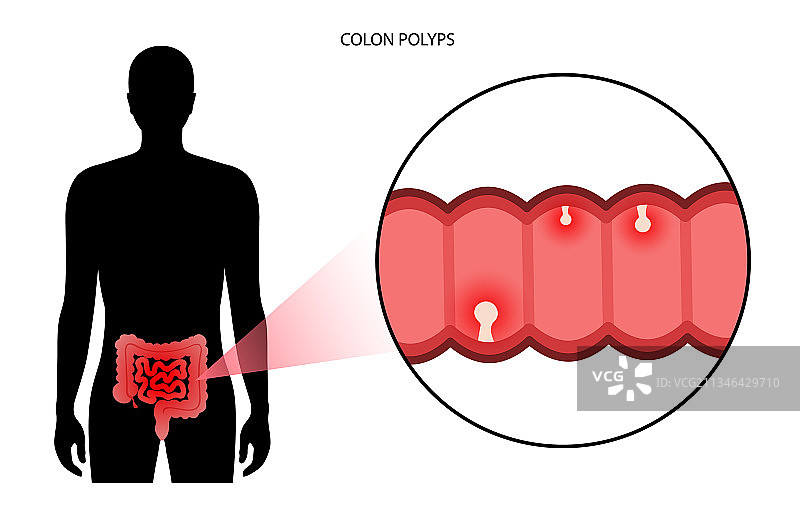 结肠息肉炎症图片素材