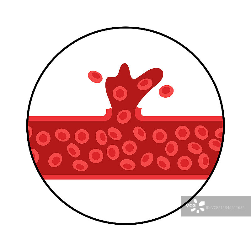 出血性脑卒中图片素材