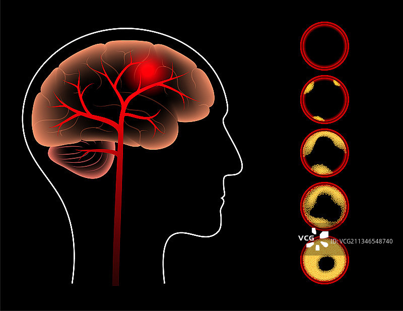 脑卒中缺血图片素材