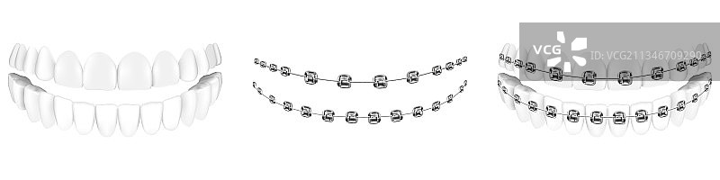 带或不带牙套的牙齿弓形牙套图片素材
