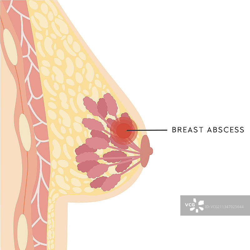 女性乳房横截面医疗信息图图片素材
