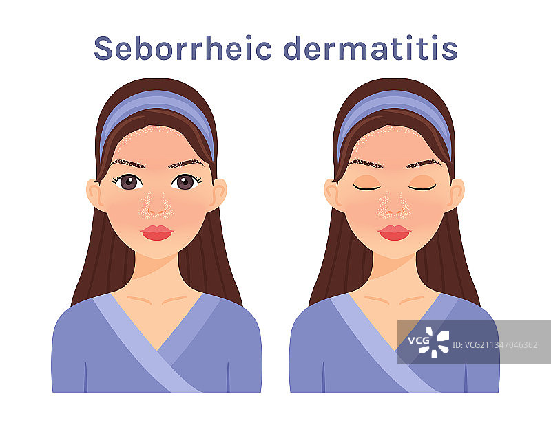 女性面部的脂溢性皮炎图片素材