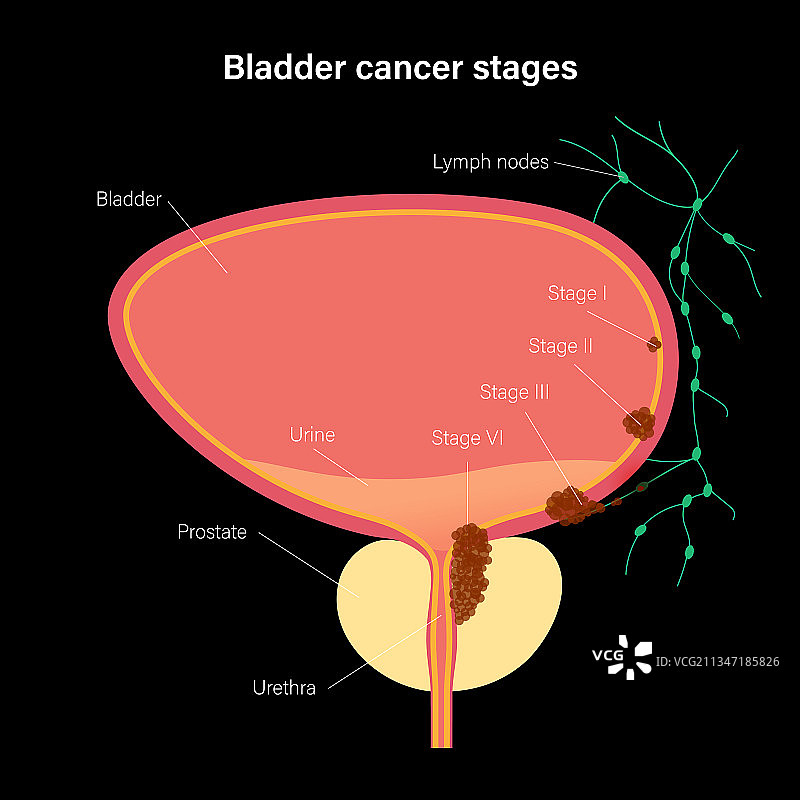 膀胱癌分期图片素材