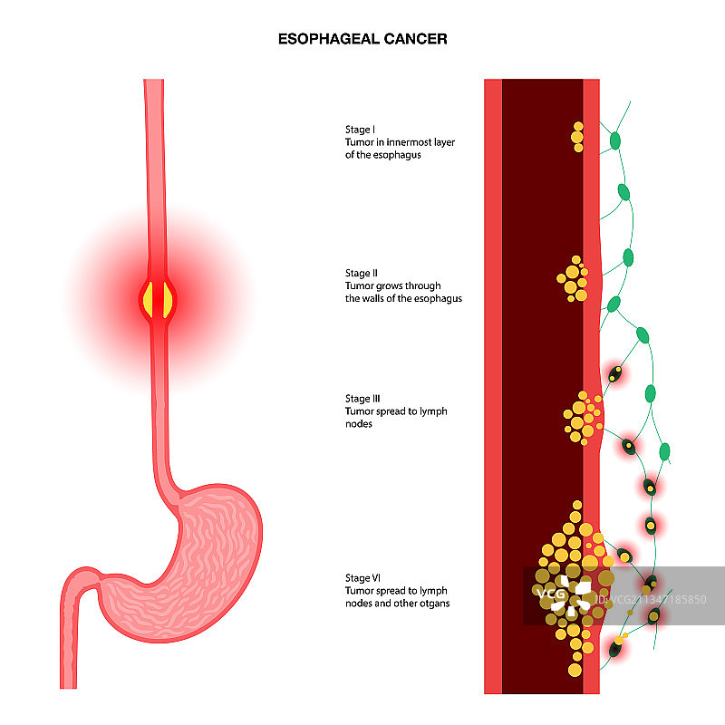 食管癌分期图片素材