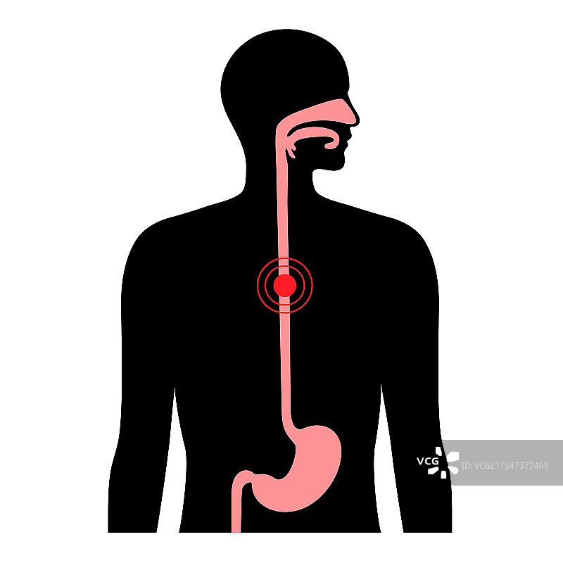 食道癌概念图片素材