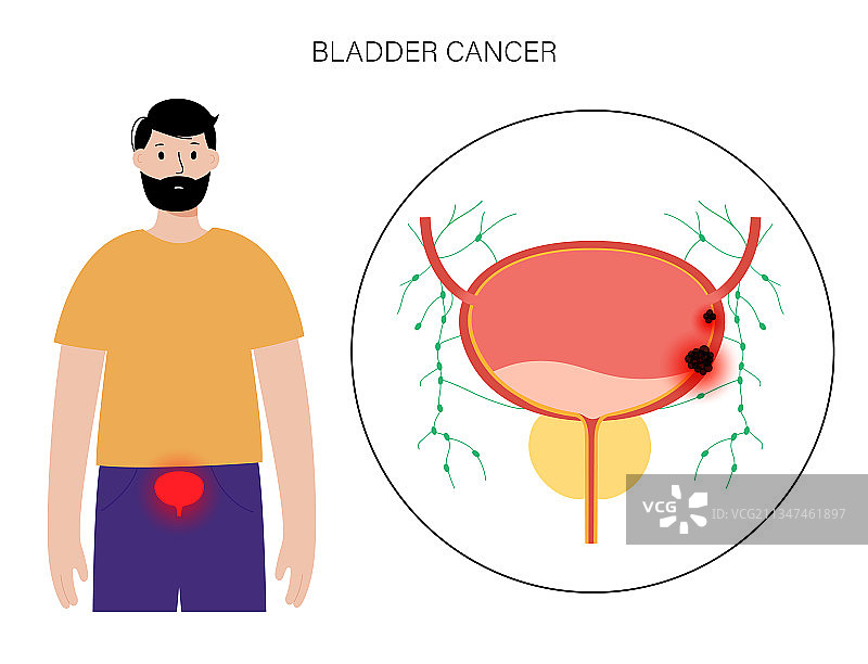 膀胱癌分期图片素材