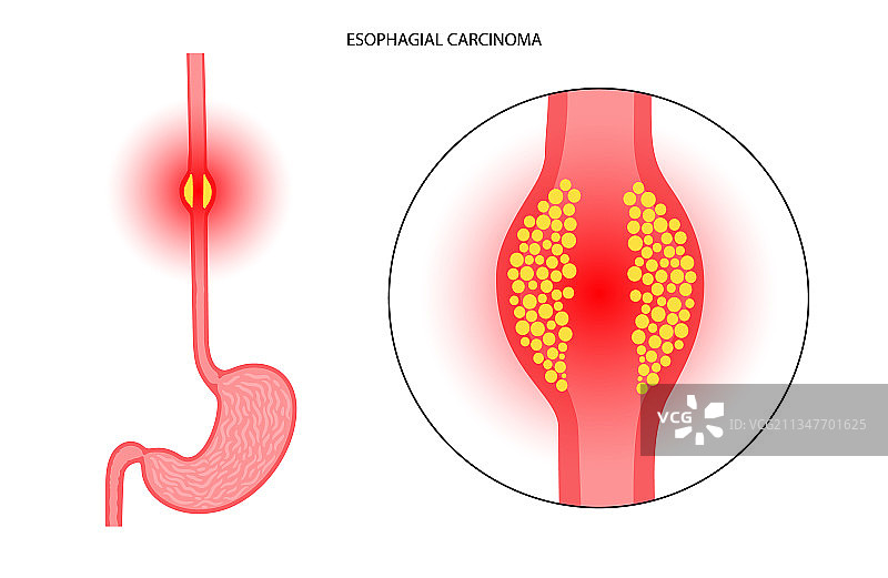 食道癌概念图片素材