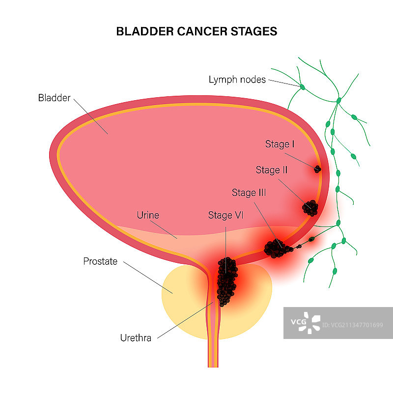 膀胱癌分期图片素材