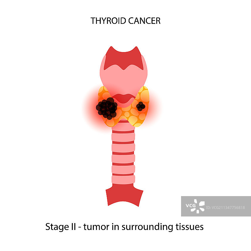 甲状腺癌分期图片素材