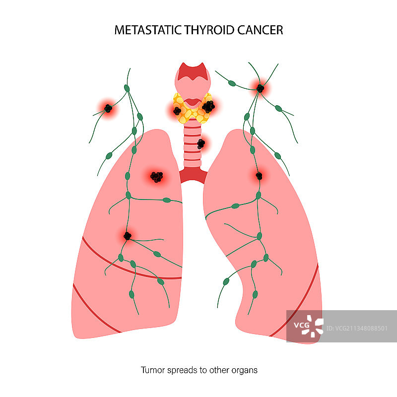 甲状腺癌分期图片素材